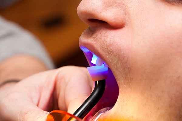 Dentist performing dental bonding treatment on patient.