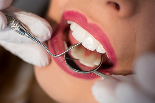 Image of a woman's teeth being cleaned by a dental professional, at Haddonfield, NJ office.