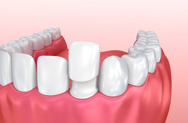 Rendering of jaw with porcelain veneer on tooth at Cleary Dental in Haddonfield, NJ