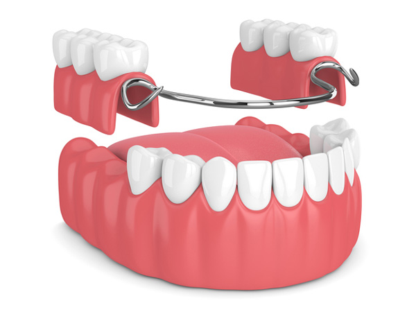 Rendering of removable partial denture at Cleary Dental in Haddonfield, NJ