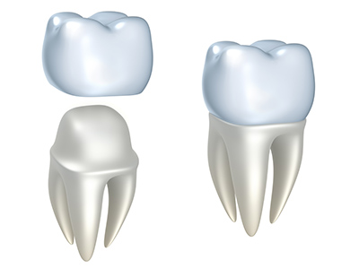 Image of a dental crown at Cleary Dental in Haddonfield, NJ.