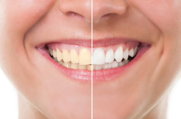 Before and after photo of teeth whitening treatment at Cleary Dental in Haddonfield, NJ