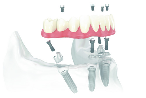 Diagram of All-on-4 Treatment Concept at Cleary Dental in Haddonfield, NJ